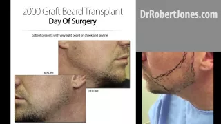 Dr Robert Jones - 2000 graft beard transplant day of surgery