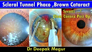 Scleral Tunnel Phaco for Very Hard Cataract. Clear Cornea Secrets. Dr Deepak Megur