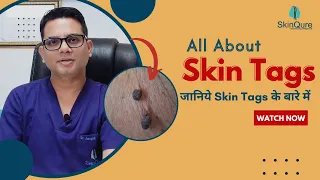 Know all about Skin Tags | Skin Tags Treatment in Delhi | SkinQure