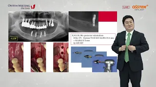 【LECTURE】Surgical options for implants in the posterior mandible (日本語同時通訳)