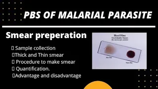 Laboratory diagnosis of malaria // PBS malaria // malaria parasites under microscope
