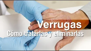 Verrugas - Qué son, cómo se contagian y tratamientos