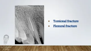 Instrument fracture in rotary endodontics - How to prevent it?