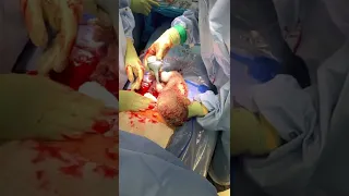 My cesarean delivery (warning lots of blood)