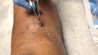 Complex Fracture Recovery Update - Staples and stitches removed