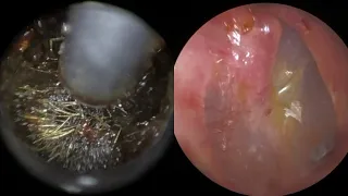 142 - Painful 4 Year Old Rock Solid Ear Wax Impacted Against Eardrum Removed Using WAXscope®️