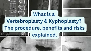 What is a Vertebroplasty & Kyphoplasty? The procedure, benefits and risks explained