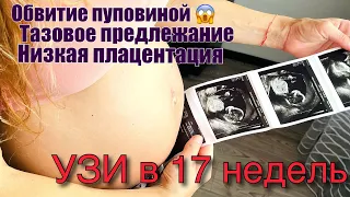 УЗИ в 17 недель| Обвитие пуповиной| Низкая плацентация| Тазовое предлежание