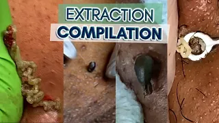 Our Best, Most Satisfying Extractions - Compilation | HueVine