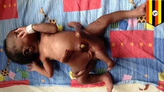 Близнец-паразит: в Уганде провели операцию ребёнку, родившемуся с четырьмя ручками и ножками