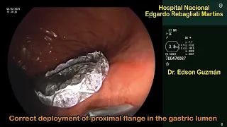 EUS-guided drainage of walled-off pancreatic necrosis with LAMS (Hot Spaxus)