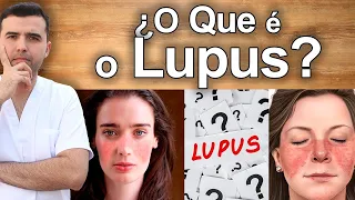 O Que é Lúpus? – Sintomas, Causas, e Tratamento Natural