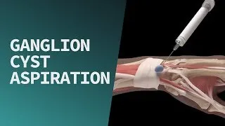 腱鞘囊腫 Ganglion Cyst Aspiration | Complete Anatomy