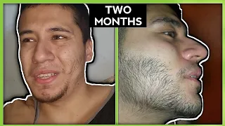 FAST Minoxidil Beard Transformation | SHOCKING | LanDope