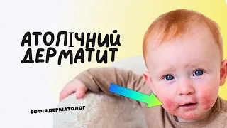 Атопічний дерматит. Найчастіші запитання. Лікар-дерматолог. Одеса