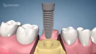 Dental Implant Procedure - One Stage