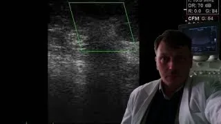Breast ultrasound - Bi-rads 4-5