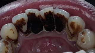 Налёт курильщика | Smoker’s Plague | Dentist | Plague remove