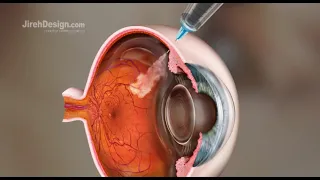 Intravitreal Injection Animation [HD]