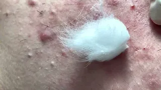 ACNE !!! ACNE !!! ( Tri Mun Da Nang Mai Ngoc )