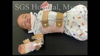 Optimally recovered Erb’s Palsy or Brachial Plexus Injury : SGS Hospital, Mysore, India - 2