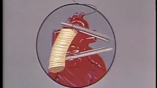 Surgical Correction of Dissecting Aneurysm of Ascending Aorta... (Baylor College of Medicine, 1963)