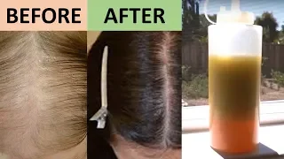 7 DAY HAIR GROWTH MIRACLE TREATMENT THAT PROMOTES HAIR GROWTH FROM THE ROOTS Natural Home Remedies