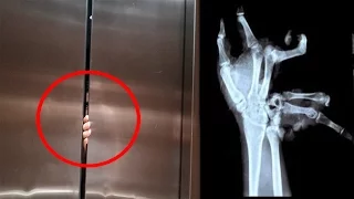 ELEVATOR CRUSHED HIS HAND!