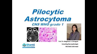 Pilocytic astrocytoma CNS WHO grade 1