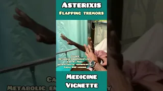 Asterixis : flapping tremors made simple for USMLE, NEET PG, NCLEX #neet #usmle #medical  #doctor