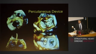 Timing of intervention in mitral regurgitation - Prof Greg Scalia