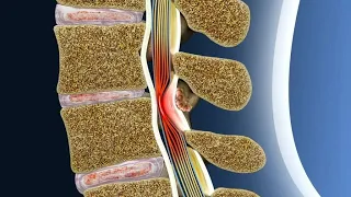 5.  Как болит стеноз позвоночного канала