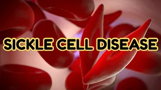 Sickle Cell Disease (updated 2023) - CRASH! Medical Review Series