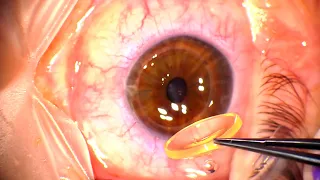 Corneal Transplant: Penetrating Keratoplasty for Advanced Keratoconus and Corneal Infiltrates