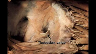 Thebesian valve