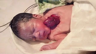 Miracle baby's heart beats outside her chest