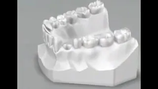 Tutti i passaggi reali dell'impianto dentale