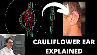 What Causes Cauliflower Ear?