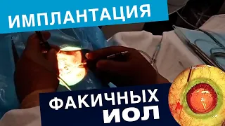 Видео из операционной: имплантация факичных линз