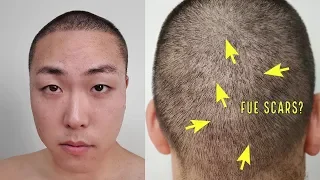 I SHAVED MY HEAD AGAIN AFTER MY HAIR TRANSPLANT USING A #1 CLIPPER...SEE MY FUE SCARS!