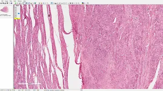 Leiomioma uterino / pólipo endometrial / hipotrofia endometrial