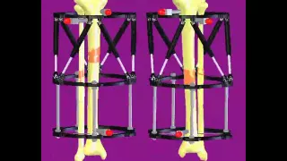 Stature Lengthening Animation LIMB LENGTHENING