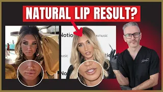 How to Create Natural Looking Lip Filler Results. Lip Filler Injection Tips