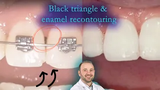 Black triangle & enamel recontouring management , selective IPR and esthetical filling restoration