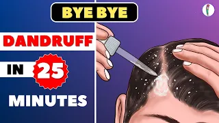 🔥#1 Dandruff Treatment at Home | How to get rid of Dandruff | Dandruff Removal | Itchy scalp