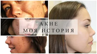 МОЯ ИСТОРИЯ ПРОБЛЕМНОЙ КОЖИ. Как избавиться от прыщей? Знакомство. #акне #проблемнаякожа #прыщи