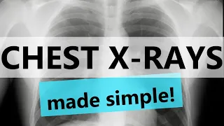 Chest X-rays (CXR) made easy! | COMPLETE GUIDE IN 12 MINUTES