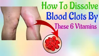 How To Dissolve Blood Clots By These 6 Vitamins #Healthy Practices 18