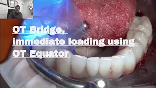 OT Bridge, immediate loading using OT Equator in fixed prosthesis   Rhein83  DDS Marco Tallarico