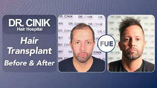 Hair Transplant Results with 4750 Grafts - Before and After | Dr. Emrah Cinik